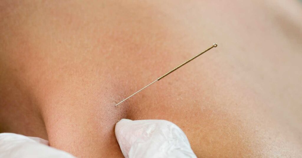Trigger Insm Photo IMS Ottawa (Intramuscular Stimulation)