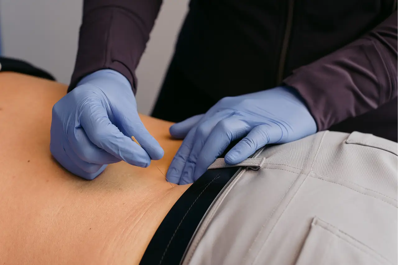 Acupuncture Services Ottawa