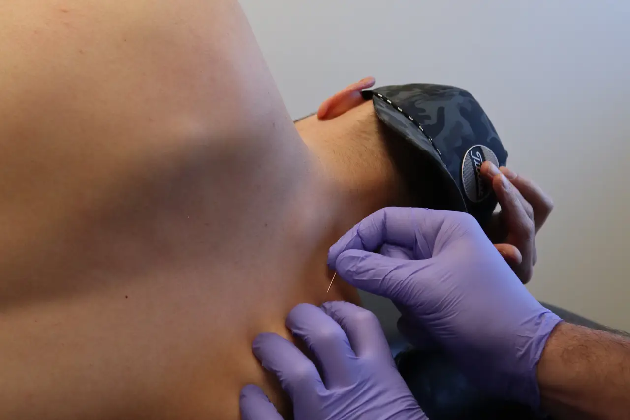 Dry Needling and GunnIMS Services in Ottawa